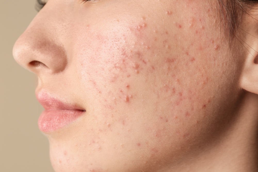 close up of teenage girl face with acne problem